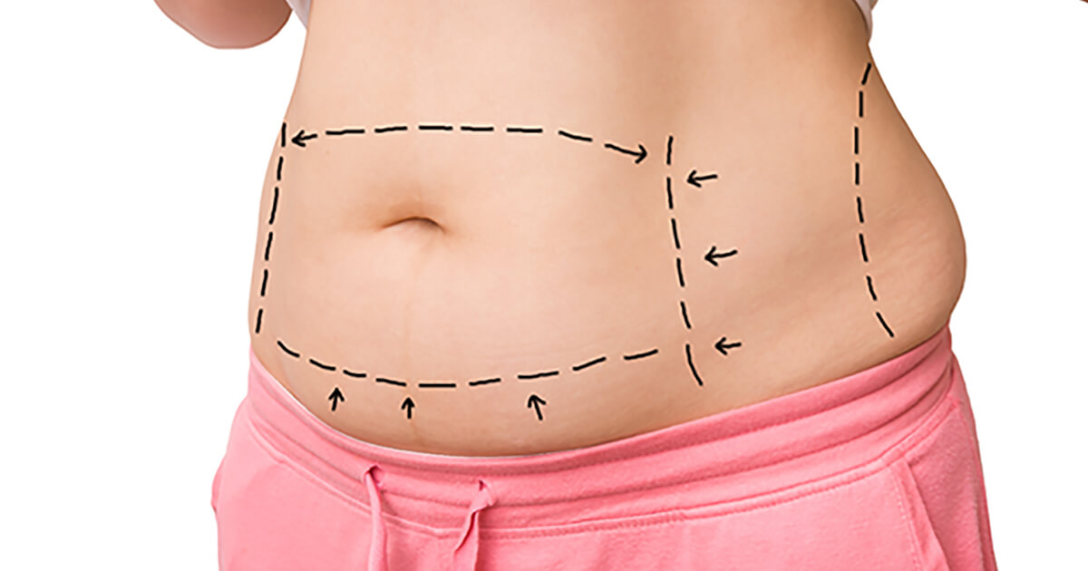 What Should I Wear after a Tummy tuck Surgery? 