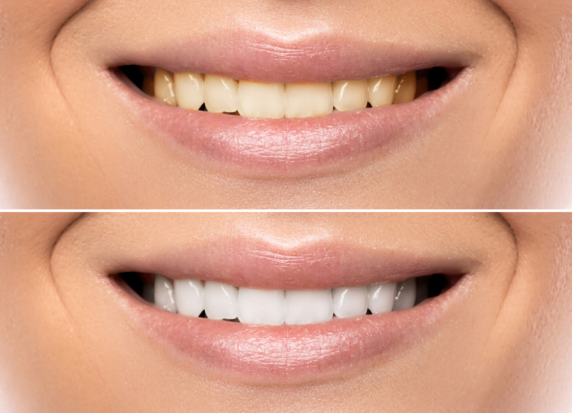 What do Celebrities use to get their teeth white? Teeth Bleaching/Teeth whitening in Bangalore 