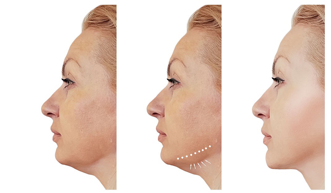 Frequently Asked Questions About Double Chin Removal Surgery
