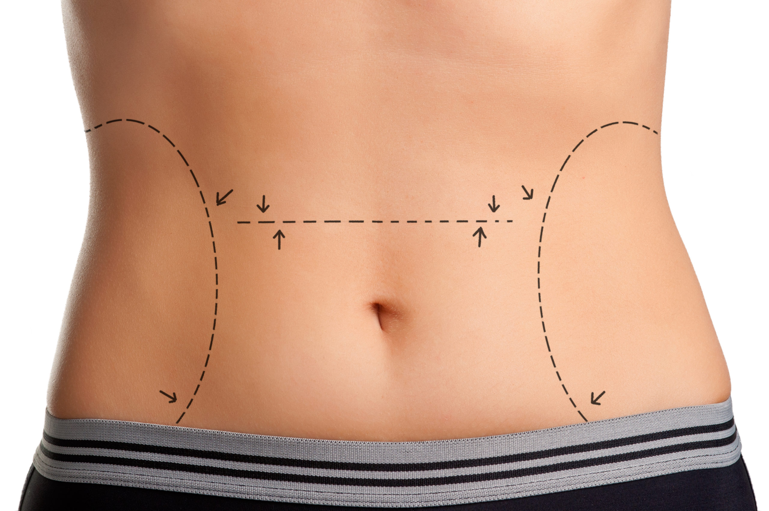 Does a Tummy Tuck Remove Stretch Marks?