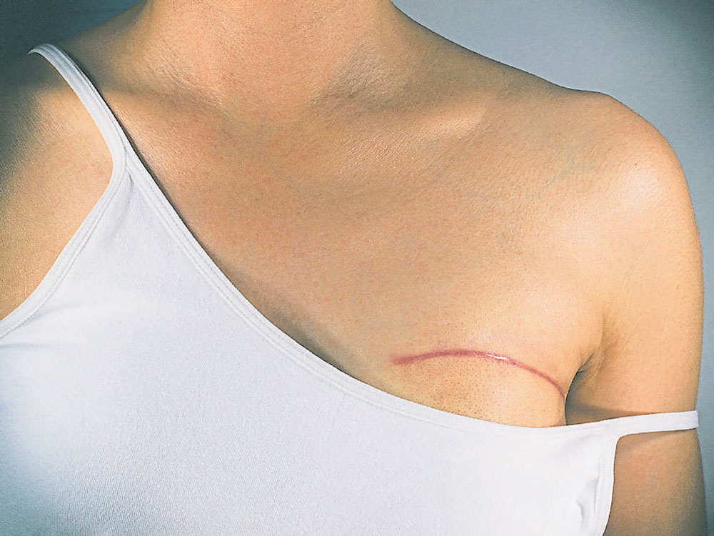 Top FAQs About Scars after Breast Surgery