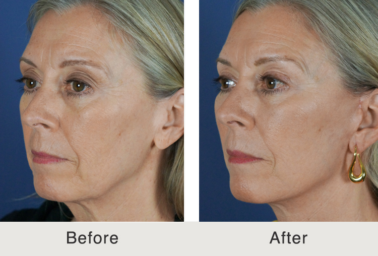 Recovery From Facelift Surgery: Do’s and Don’ts