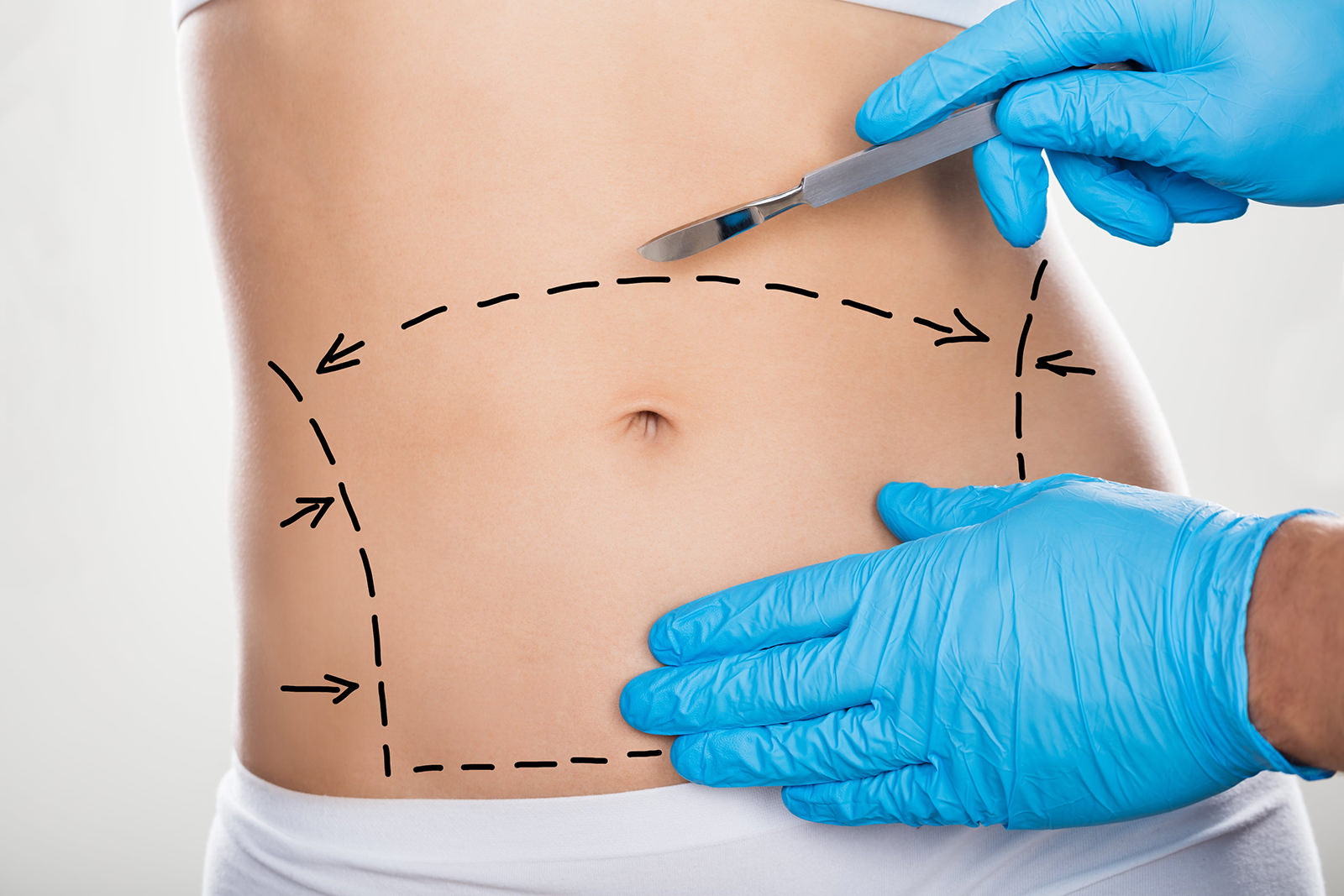What is the Cost of Liposuction| Body Contouring Procedure in India