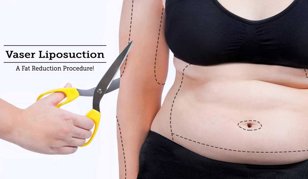 How Safe is VASER Liposuction?