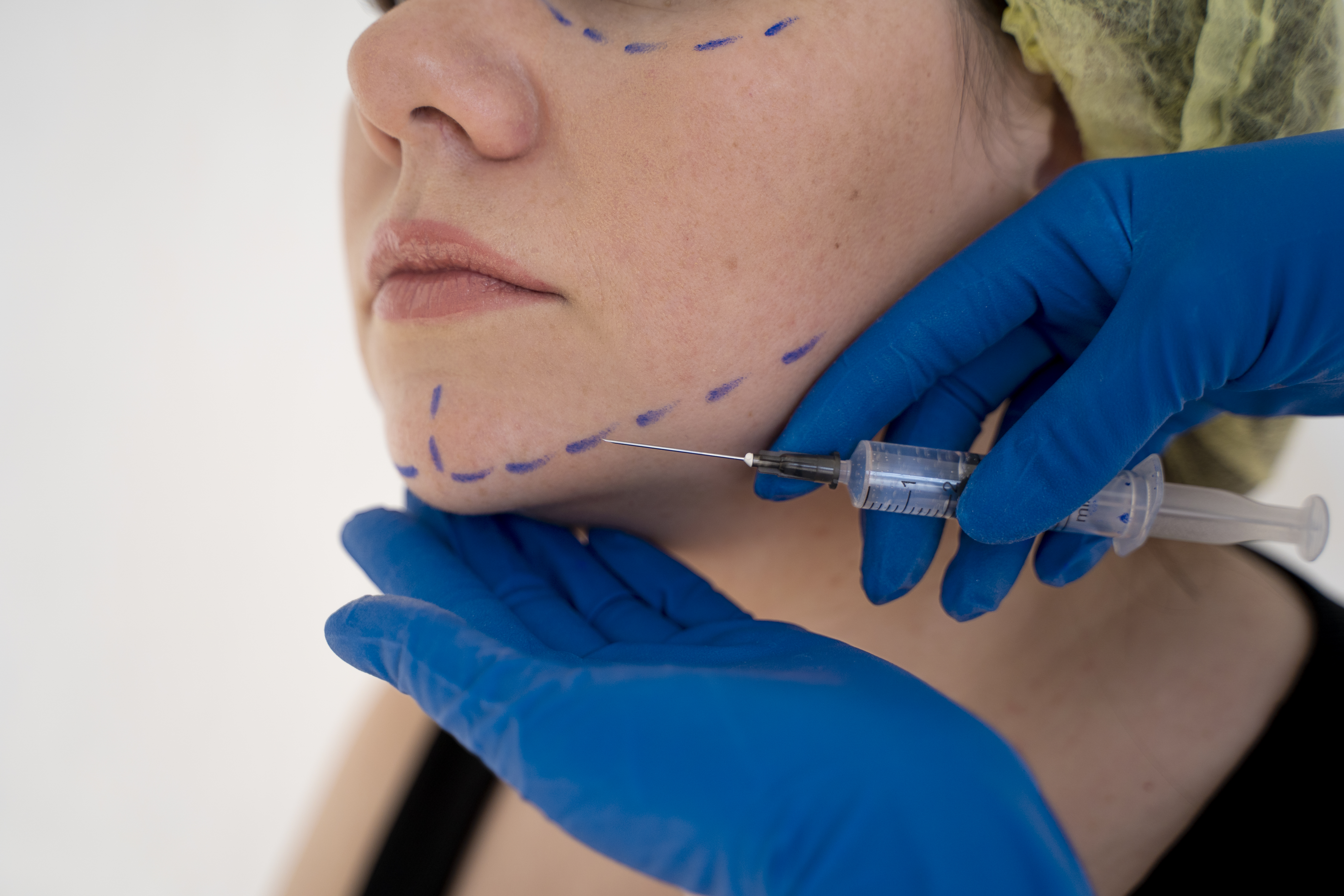 Scarless Beauty: Advancements in Minimal Scar Surgery