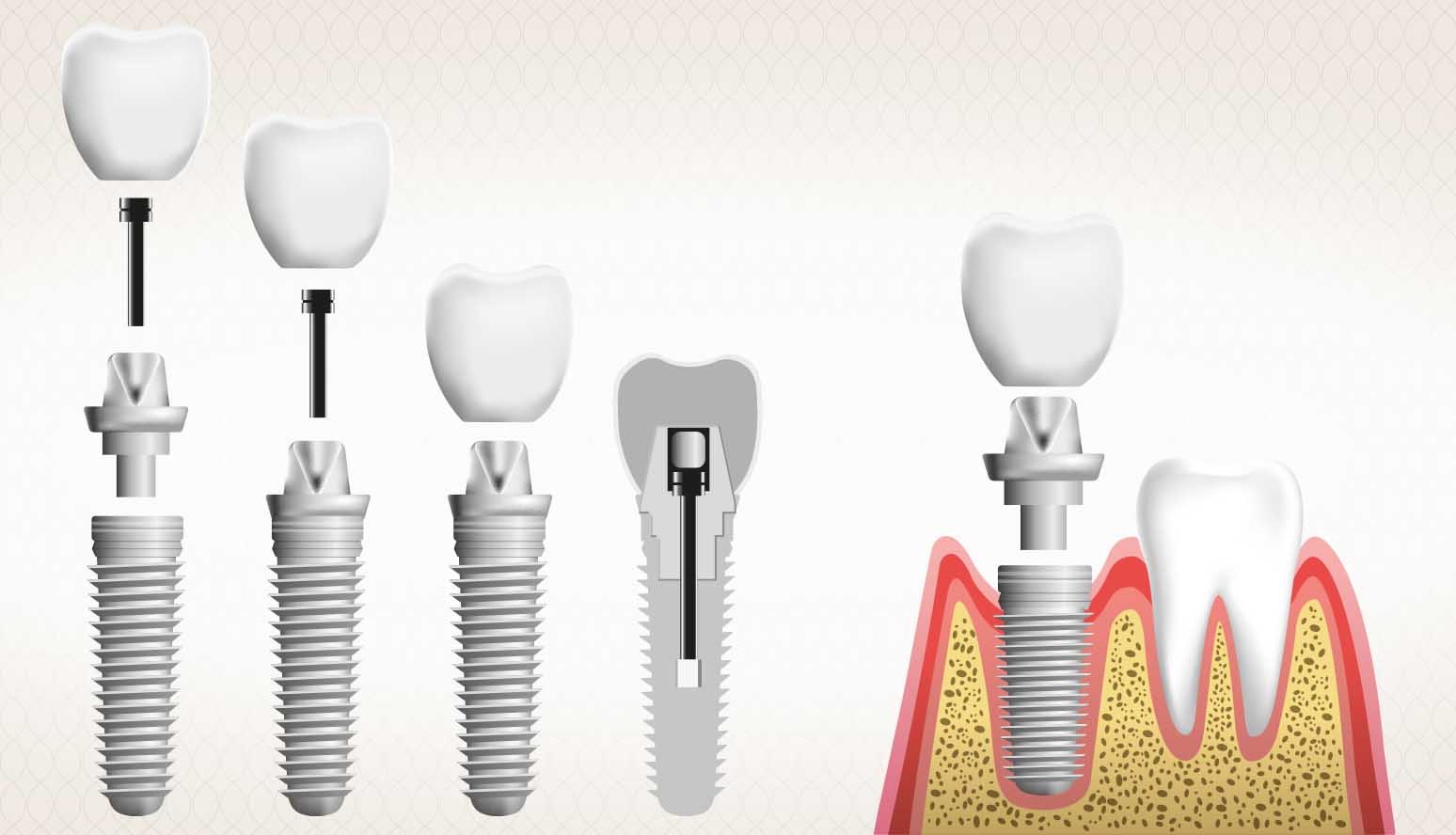 What Are Dental Implants: Cost & Benefits