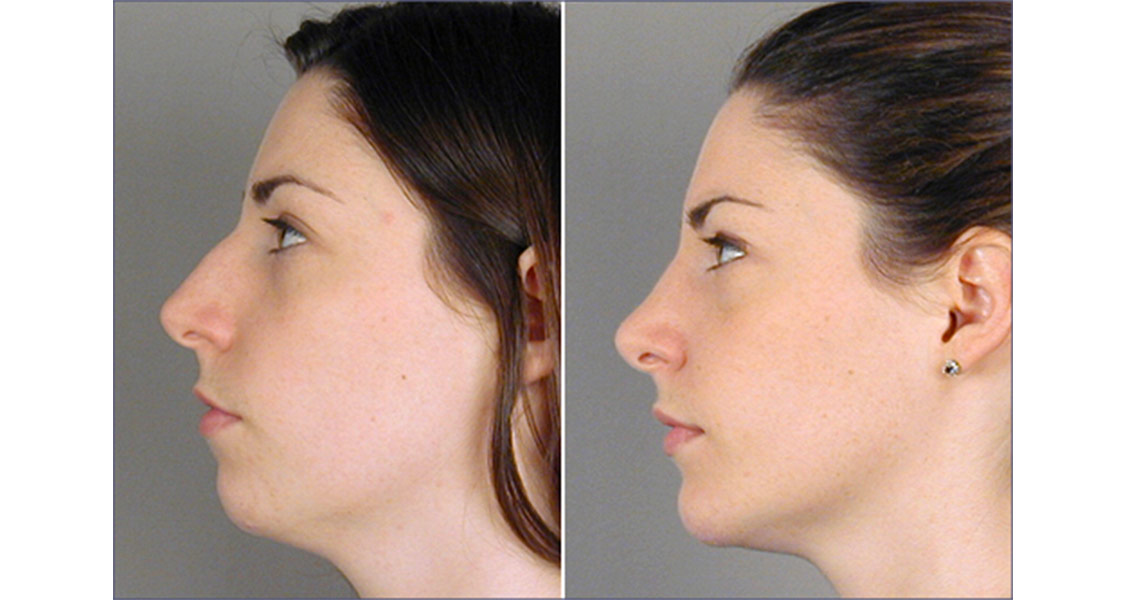 Facial Symmetry and Beauty: The Impact of Chin Augmentation
