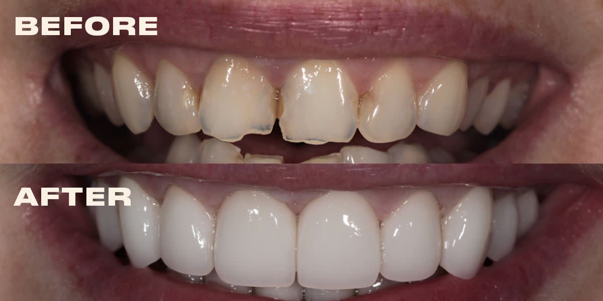 What to Expect When Getting Veneers: Pre-and-post Procedure?