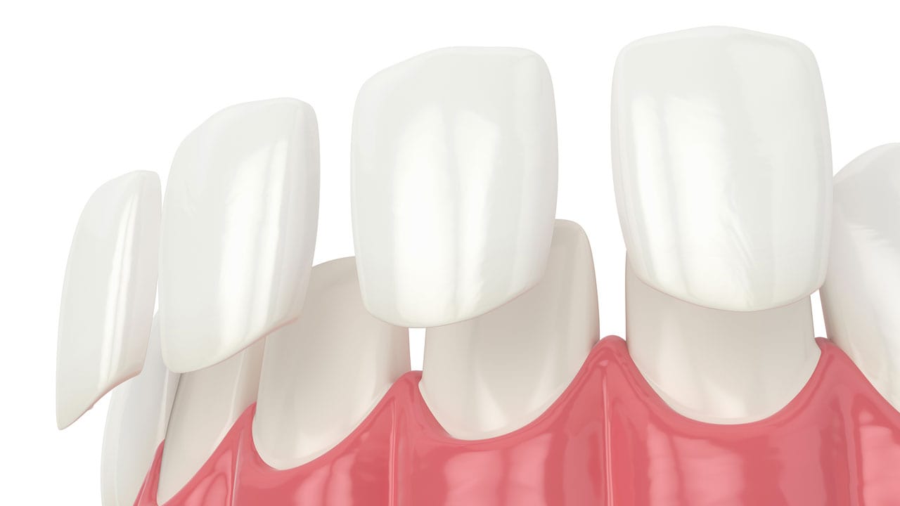 Porcelain Or Ceramic Veneers? How Are They Different? Which Is Right for You?