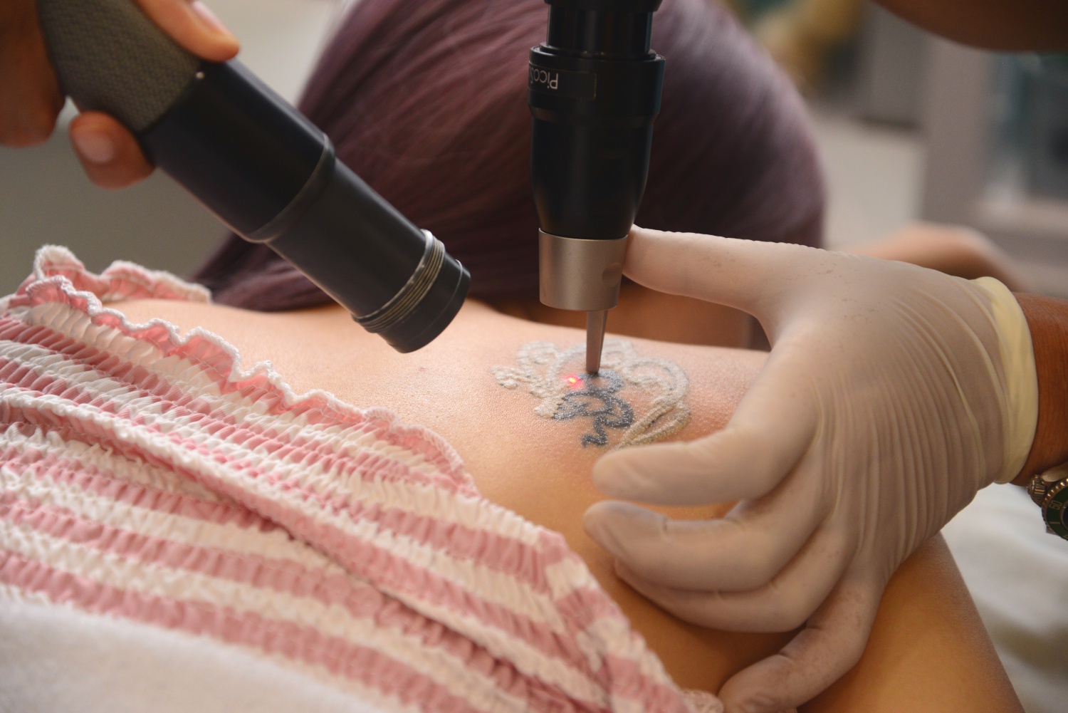 LASER Treatment for Tattoos in Bangalore