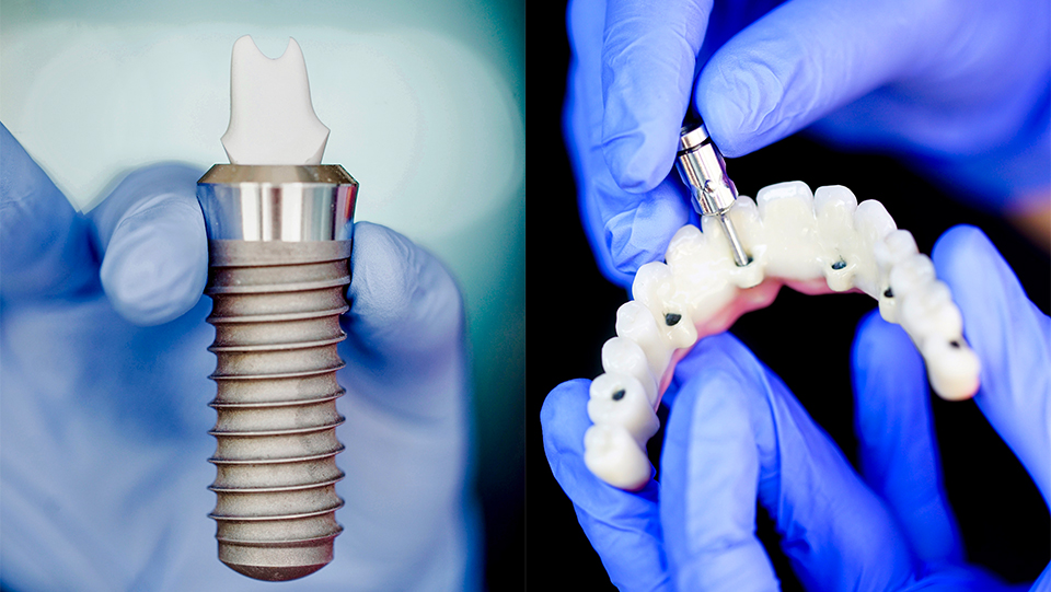 5 Dental Implant Complications to Look Out For