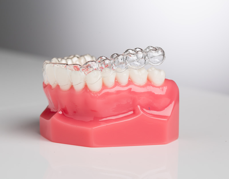 How Do Aligners Work? The Ultimate Guide 2024