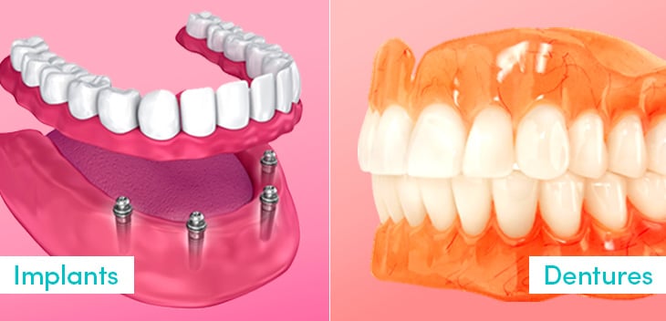 Dentures Vs Implants: Choosing the Right Fit for Your Smile