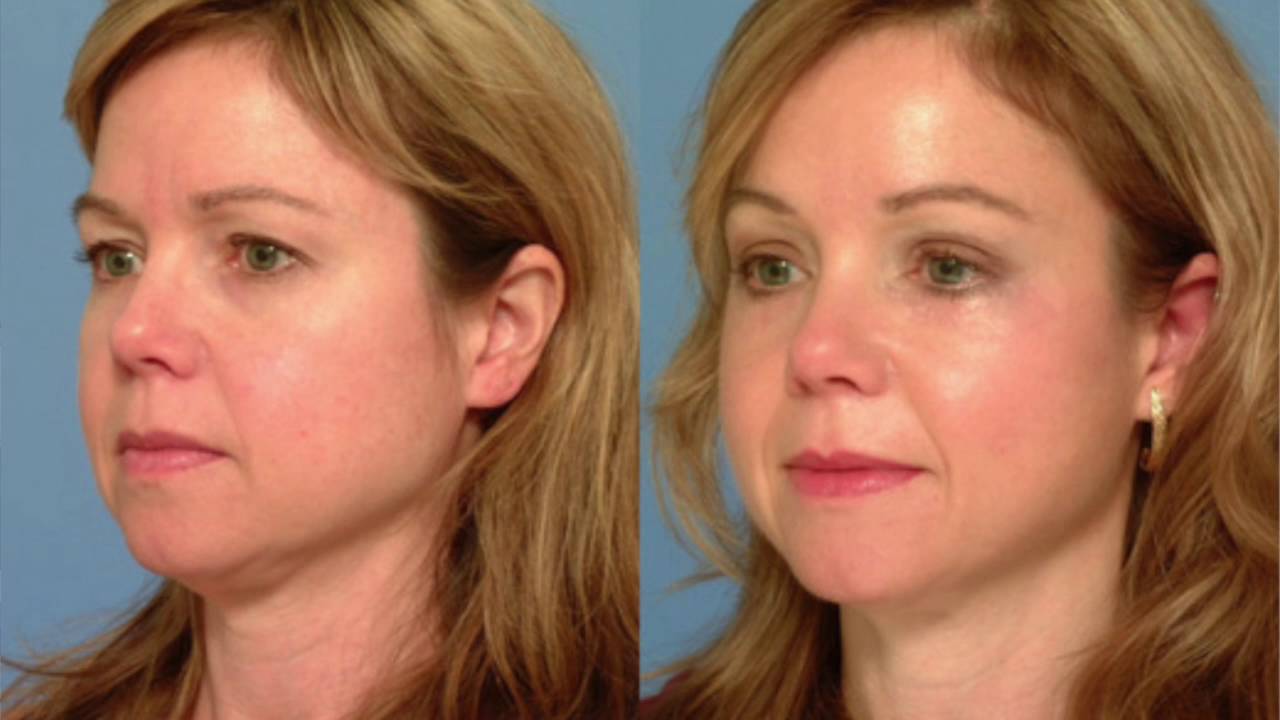 Customizing Your Transformation: Personalized Approach to Facelift Surgery