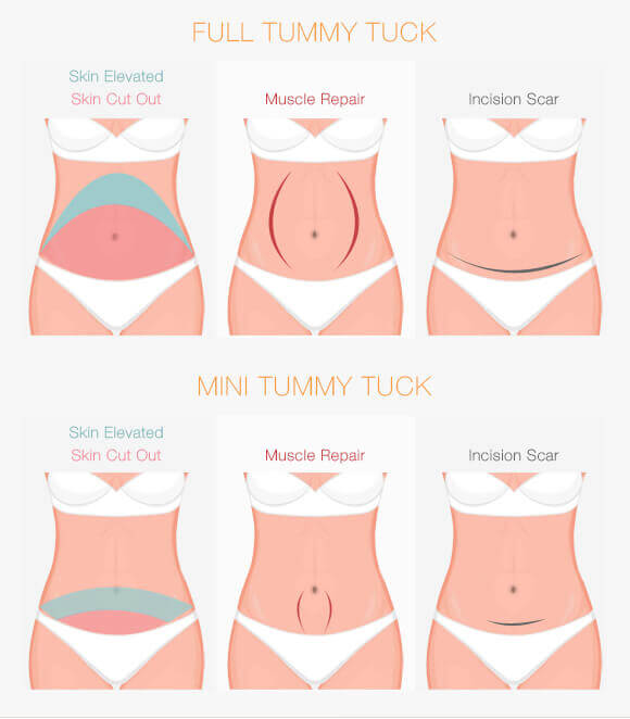 Mini Tummy Tuck or Full Tummy Tuck: What Should Be Your Option?