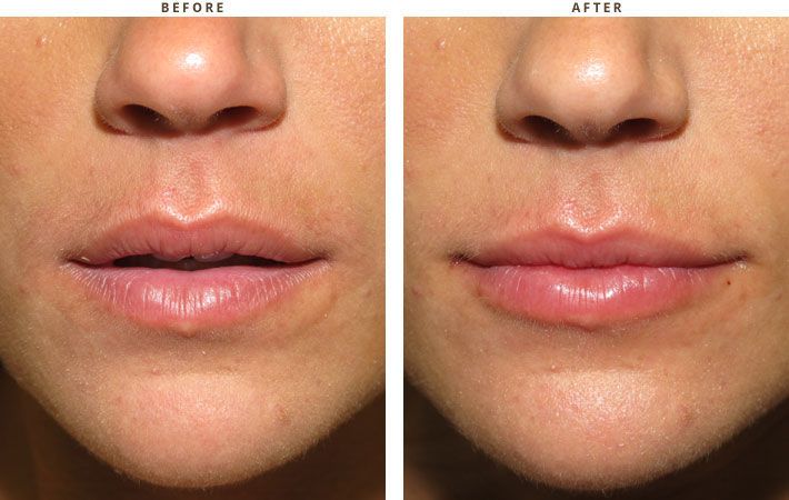 What is Lip Lift, And Are You the Right Fit for Restoring the Youthful Appearance? 