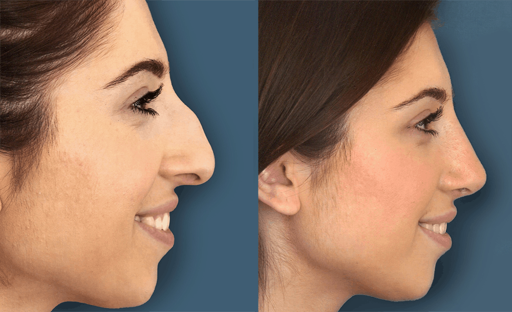 How to Know If You Need Revision Rhinoplasty 