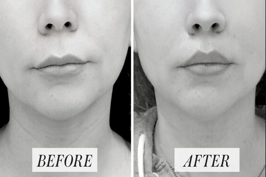 Lip lifting surgery- why and how?