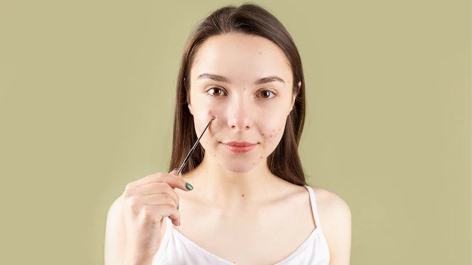 Four tips to help fade away post-acne marks and dark spots