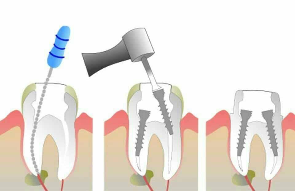 Endodontic Treatment in Bangalore by Kaesthetics