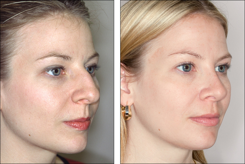 Cosmetic vs. Medical Reasons for a Nose Job | Rhinoplasty Surgery 
