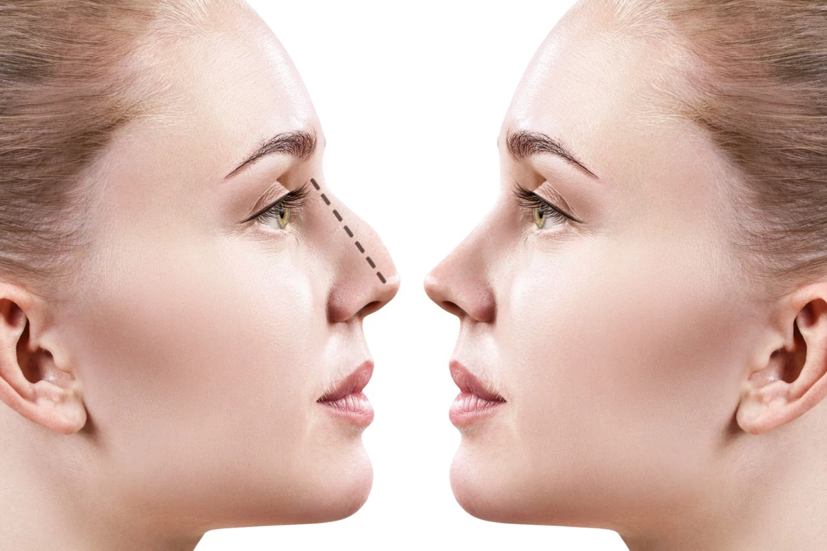 What are the top 4 Tips for Facial feminization Rhinoplasty/ Nose Job?
