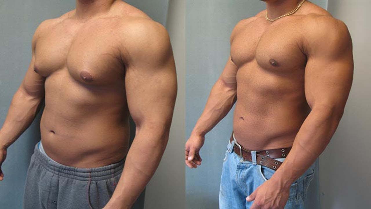 Top 5 FAQs about Recovery after Gynecomastia Surgery/ Male Breast Reduction