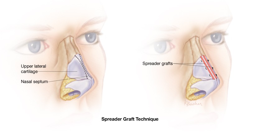 What are Spreader Grafts:  How does it improve breathing in patients with Chronic Nasal congestion?