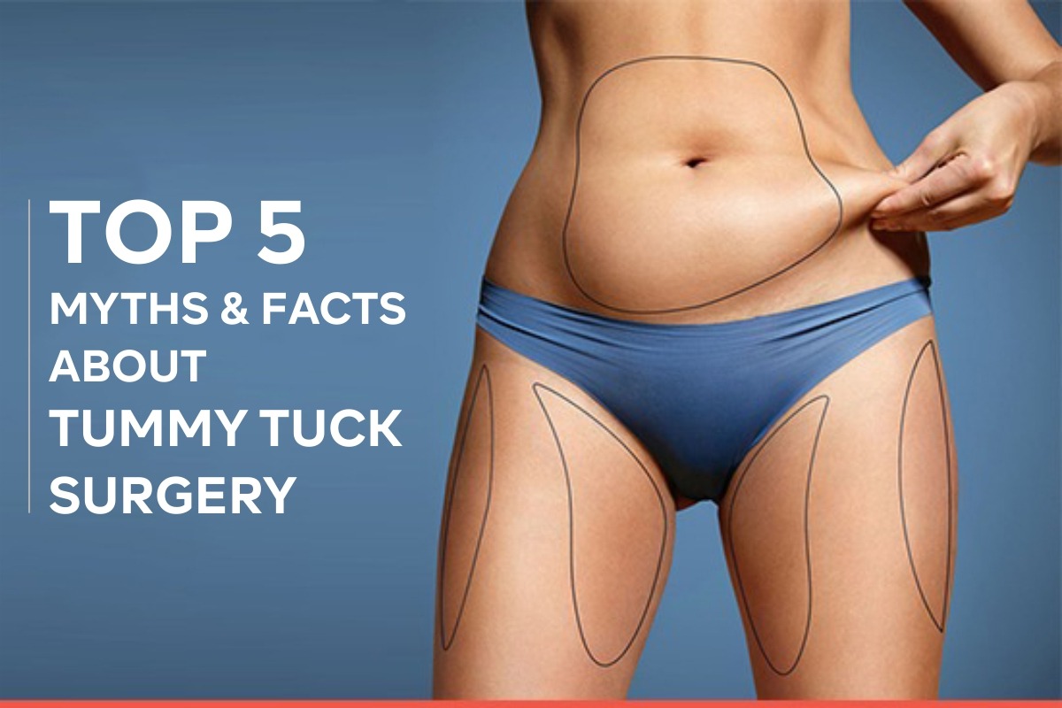 Top 5 Myths & Facts about Tummy Tuck Surgery