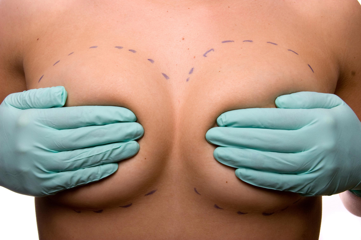 Breast Augmentation in the View of Implants: Top 5 Facts to Check about