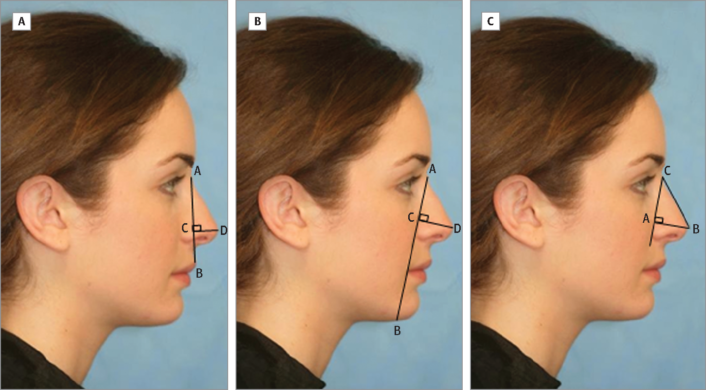Nose job for Pronounced Nasal Shape and Wide tip: What to Know & How to Act