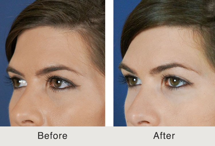 How to Treat Signs of Ageing with Brow Lift Surgery: Top 5 Facts You Must be Aware Of