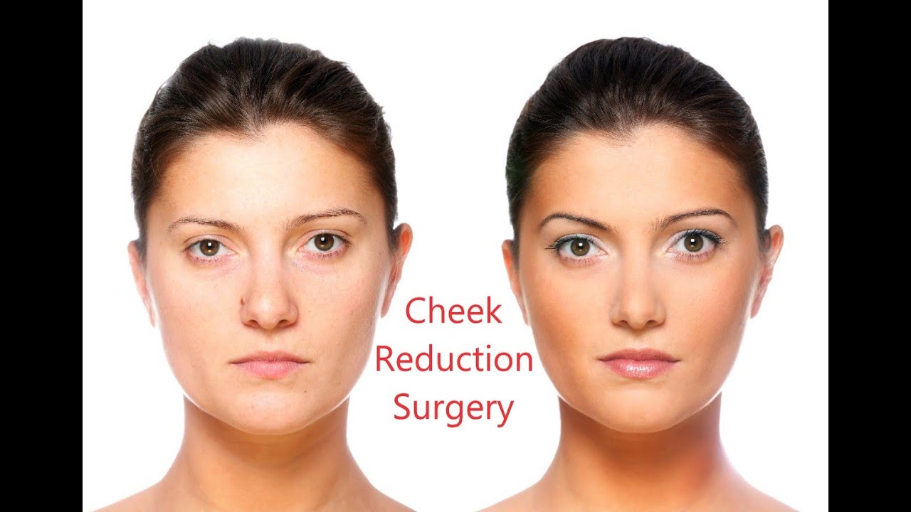Buccal Fat Removal/Cheek Reduction Surgery in Bangalore