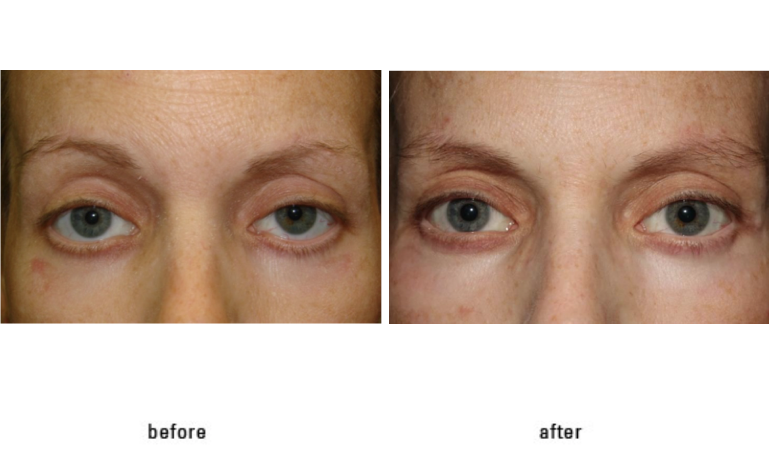 Don’t Neglect Your Eyes Know More About the Eye Lift And Blepharoplasty Surgery