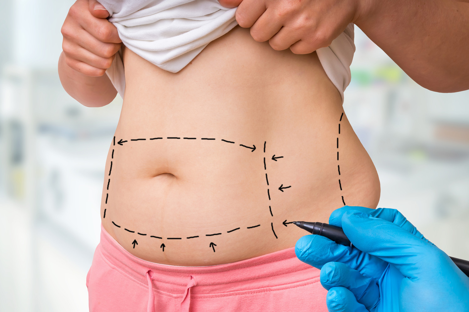 Top 5 Facts That You Must Know about Liposuction