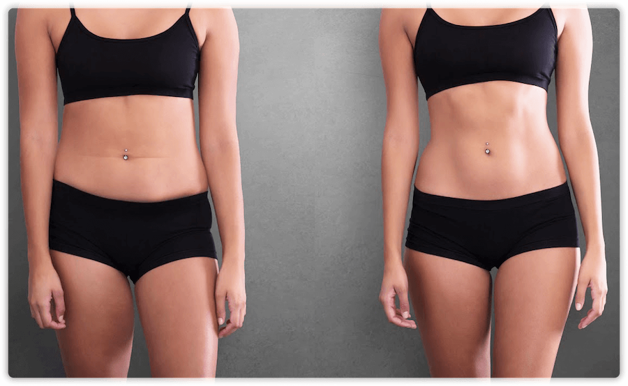 What are the Benefits of Fat Transfer in Body Contouring