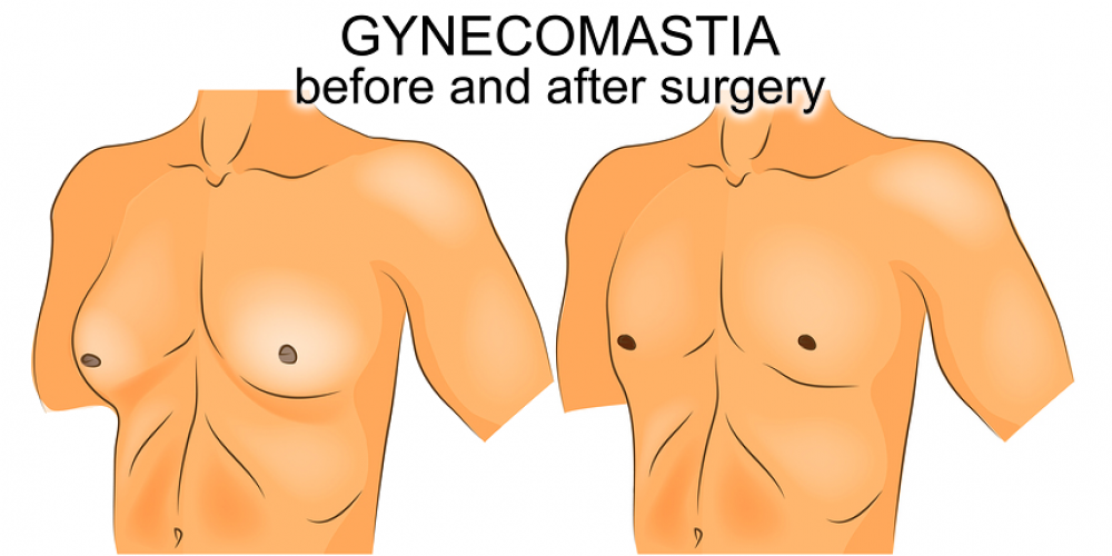 What is Gynecomastia and Why Should You Undergo this Procedure