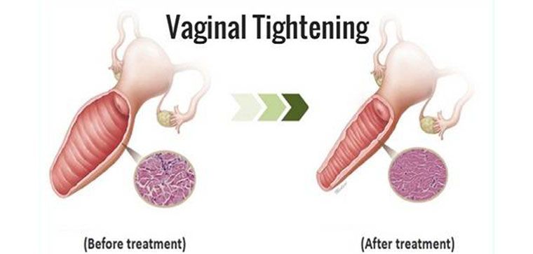 Top Things to Check When Considering Vaginal Tightening with Femilift