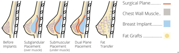 Top 4 Benefits of Fat Grafting for Breast Augmentation