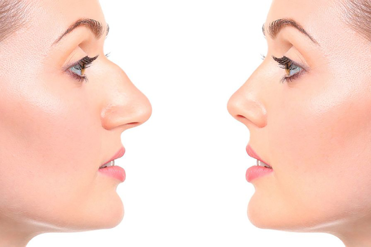 What You Need to Know about Septoplasty (Nose) Surgery in Bangalore