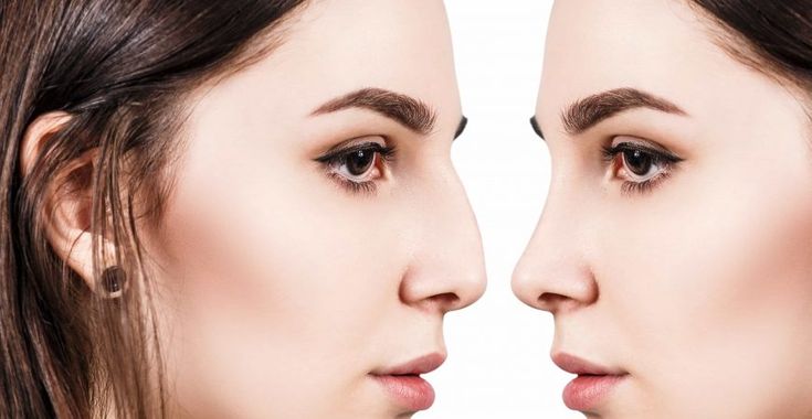 What are the Benefits of Rhinoplasty Surgery