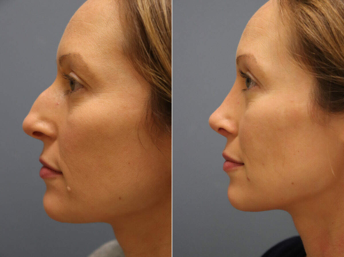 What are the Top 5 Benefits of a Nonsurgical Rhinoplasty | Nose Job