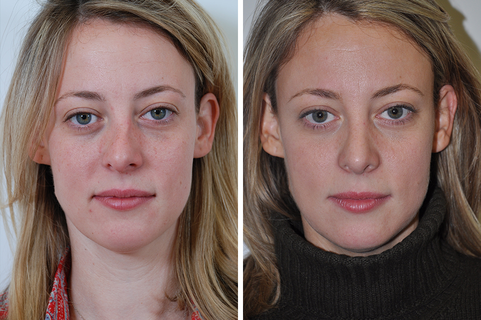 Top 7 Tips About How to Speed up Your Rhinoplasty Recovery