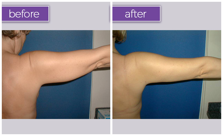 How Do You Get Rid of Arm Fat Permanently?