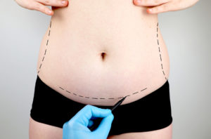 Post-op Tummy tuck Scarring Questions