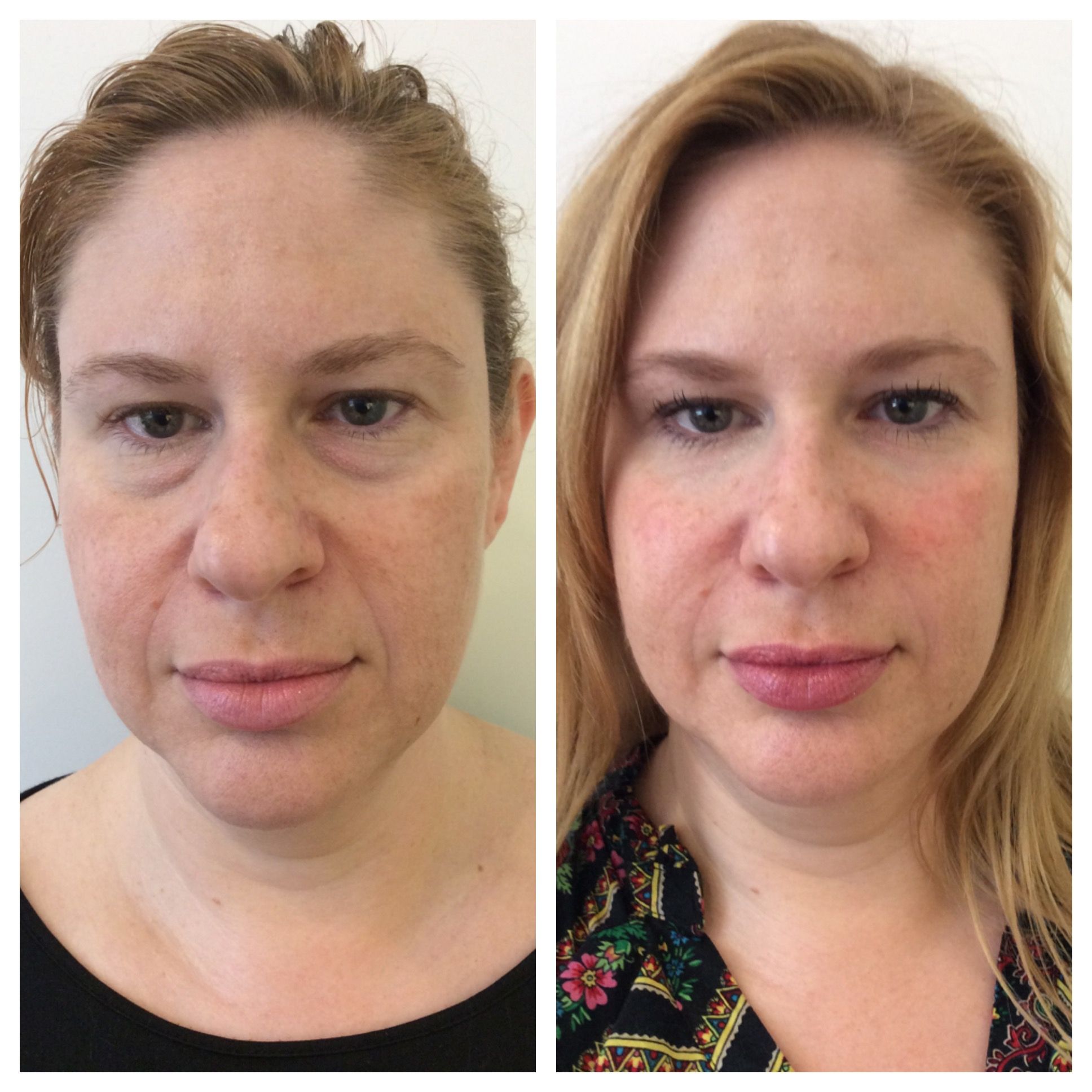 How to Care for your Non-surgical Rhinoplasty Results
