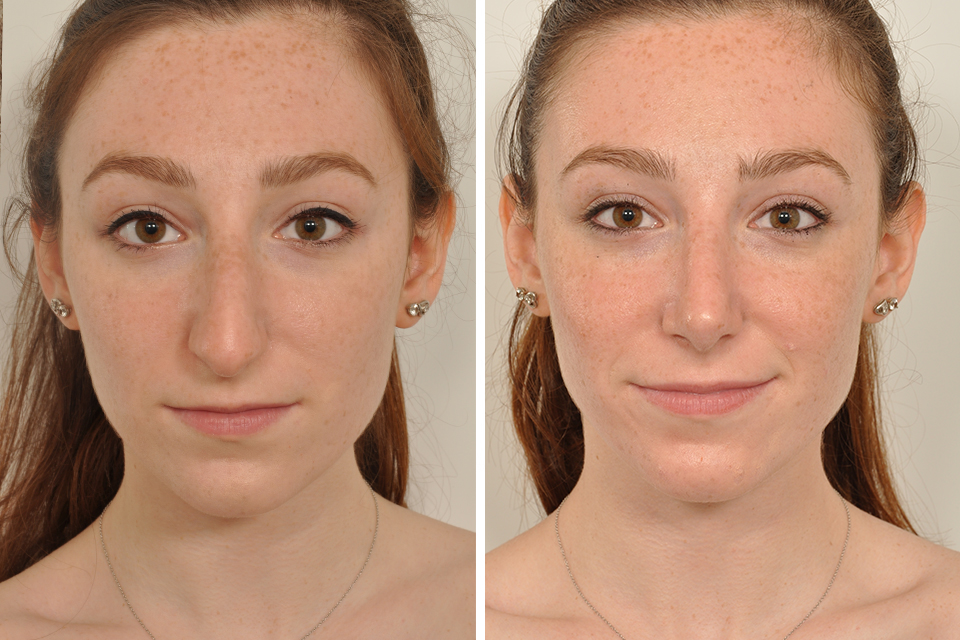 What Is the Age Minimum for Rhinoplasty Surgery?