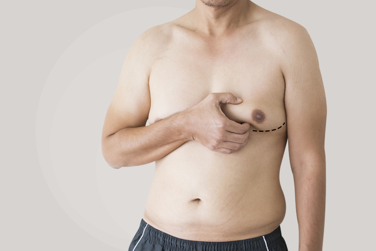 Top 8 Quick Facts about Gynecomastia / Male Breast Reduction Surgery 