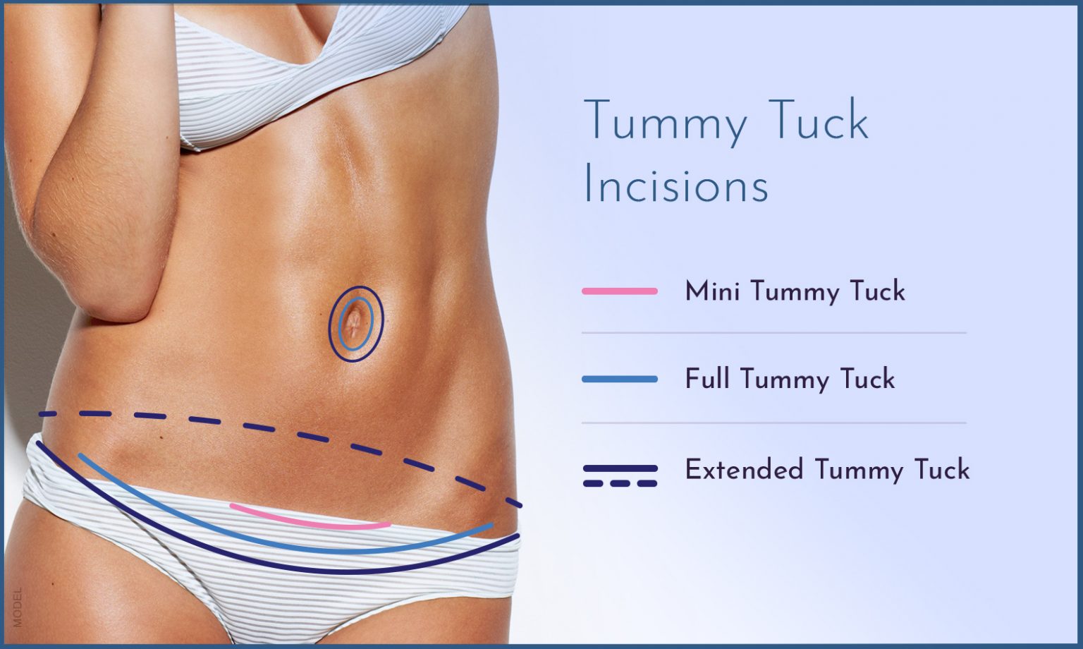 Medical Benefits of a Tummy Tuck Surgery