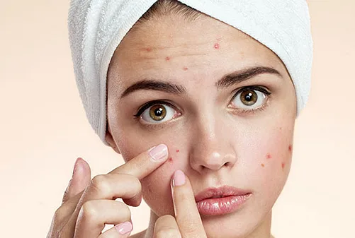 acne/acne scar treatment